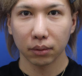 30代男性の人中短縮(リップリフト) After 症例写真