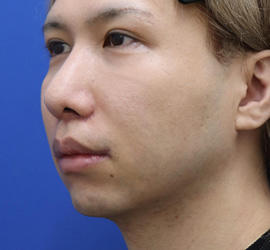 30代男性の人中短縮(リップリフト) After 症例写真