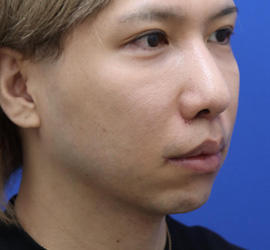 30代男性の人中短縮(リップリフト) After 症例写真