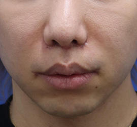30代男性の人中短縮(リップリフト) After 症例写真