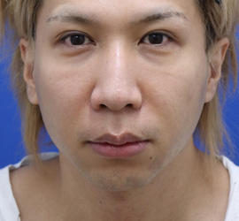 30代男性の人中短縮(リップリフト) Before 症例写真