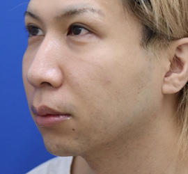 30代男性の人中短縮(リップリフト) Before 症例写真