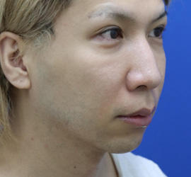 30代男性の人中短縮(リップリフト) Before 症例写真