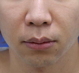 30代男性の人中短縮(リップリフト) Before 症例写真