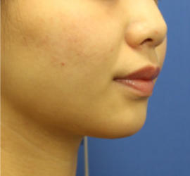 20代女性の顔の脂肪吸引  After 症例写真