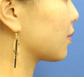 20代女性の顔の脂肪吸引  After 症例写真