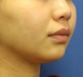 20代女性の顔の脂肪吸引  Before 症例写真