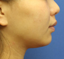 20代女性の顔の脂肪吸引  Before 症例写真