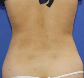 20代女性の脂肪吸引 After 症例写真