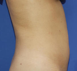 20代女性の脂肪吸引 After 症例写真