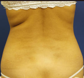 20代女性の脂肪吸引 Before 症例写真