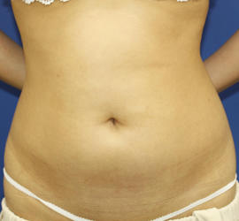 20代女性の脂肪吸引 Before 症例写真