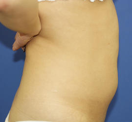 20代女性の脂肪吸引 Before 症例写真