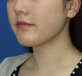 20代女性の顔の脂肪吸引  After 症例写真