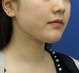 20代女性の顔の脂肪吸引 After 症例写真