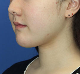 20代女性の顔の脂肪吸引  Before 症例写真