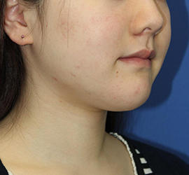 20代女性の顔の脂肪吸引 Before 症例写真