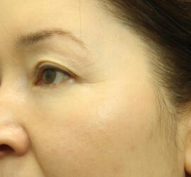 40代女性の3Dリポアイリフト  After 症例写真