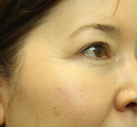 40代女性の3Dリポアイリフト  After 症例写真