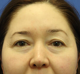 40代女性の3Dリポアイリフト Before 症例写真
