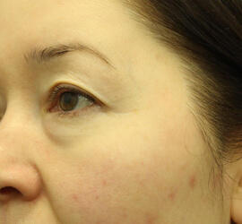 40代女性の3Dリポアイリフト  Before 症例写真