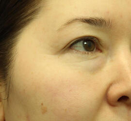 40代女性の3Dリポアイリフト  Before 症例写真