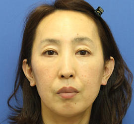 40代女性の肌再生高純度脂肪注入（脂肪移植） After 症例写真