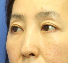 40代女性の肌再生高純度脂肪注入（脂肪移植） After 症例写真