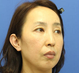 40代女性の肌再生高純度脂肪注入（脂肪移植） After 症例写真