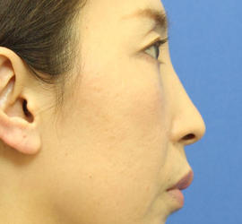 40代女性の肌再生高純度脂肪注入（脂肪移植） After 症例写真