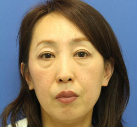 40代女性の肌再生高純度脂肪注入（脂肪移植） Before 症例写真