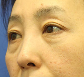 40代女性の肌再生高純度脂肪注入（脂肪移植） Before 症例写真