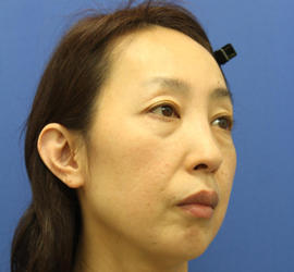 40代女性の肌再生高純度脂肪注入（脂肪移植） Before 症例写真