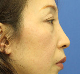 40代女性の肌再生高純度脂肪注入（脂肪移植） Before 症例写真