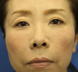 40代女性の肌再生高純度脂肪注入（脂肪移植） After 症例写真