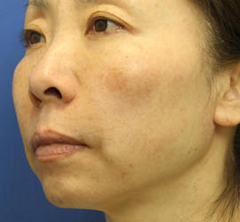 40代女性の肌再生高純度脂肪注入（脂肪移植） After 症例写真