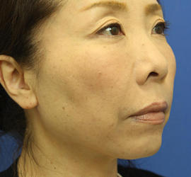 40代女性のシワ・たるみ After 症例写真