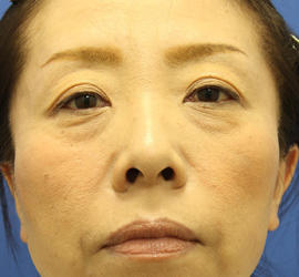 40代女性の肌再生高純度脂肪注入（脂肪移植） Before 症例写真