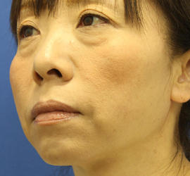 40代女性の肌再生高純度脂肪注入（脂肪移植） Before 症例写真