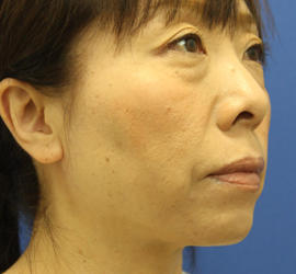 40代女性のシワ・たるみ Before 症例写真