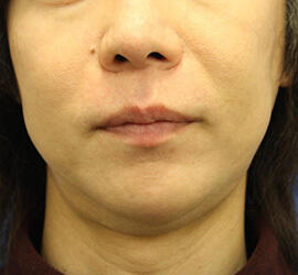 30代男性の小林式ニキビ治療法 After 症例写真