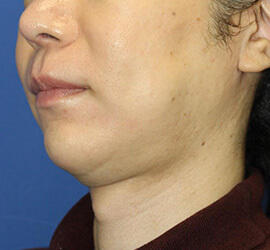 30代男性の小林式ニキビ治療法 After 症例写真