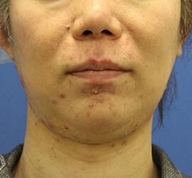 30代男性の小林式ニキビ治療法 Before 症例写真