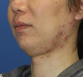 30代男性の小林式ニキビ治療法 Before 症例写真