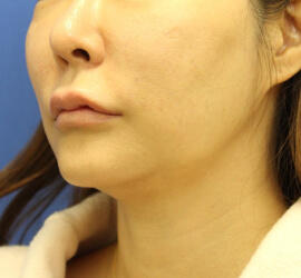 40代女性の After 症例写真