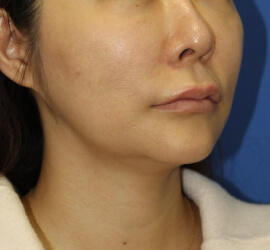 40代女性のシワ・たるみ After 症例写真