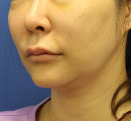 40代女性の Before 症例写真