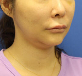 40代女性のシワ・たるみ Before 症例写真