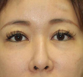 40代女性の目頭切開 After 症例写真