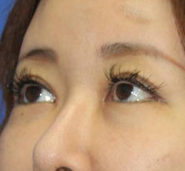 40代女性の目頭切開 After 症例写真